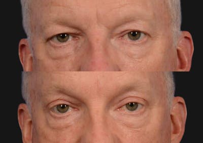 Brow Lift Before & After Gallery - Patient 136742 - Image 2