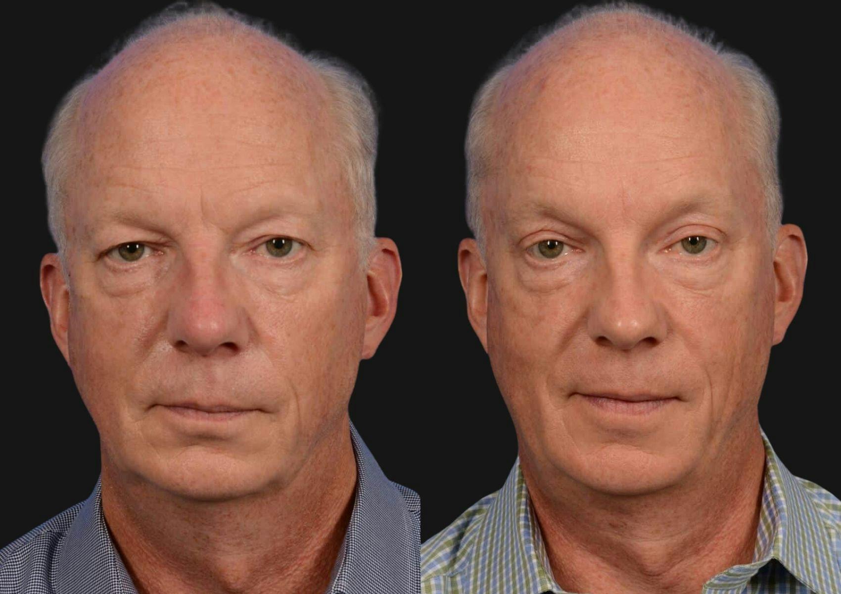 Brow Lift Before & After Gallery - Patient 136742 - Image 1