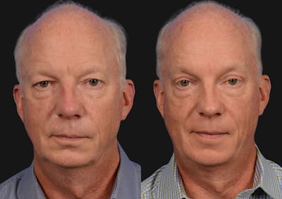 Brow Lift Before & After Gallery - Patient 136742 - Image 1