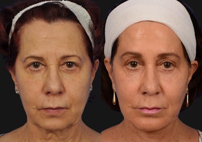 Brow Lift Before & After Gallery - Patient 577902 - Image 1