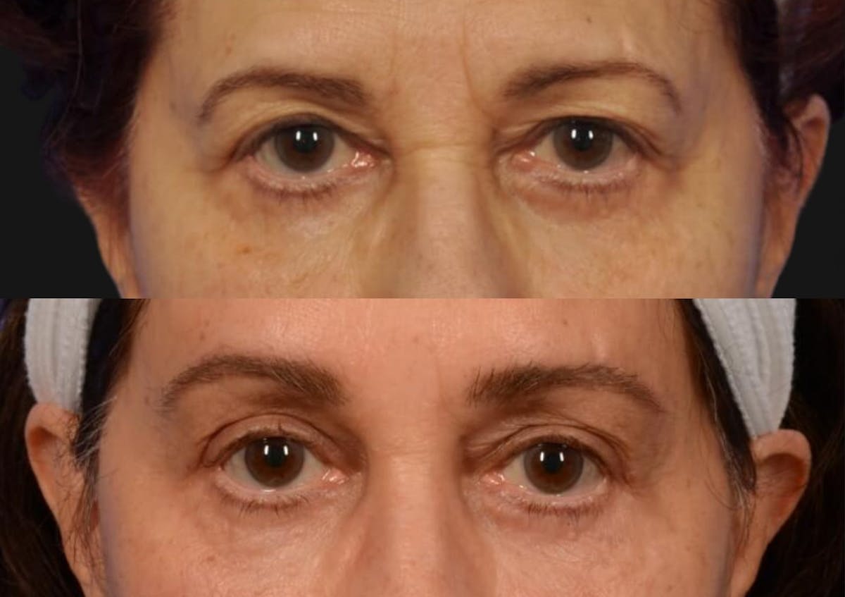 Brow Lift Before & After Gallery - Patient 577902 - Image 2