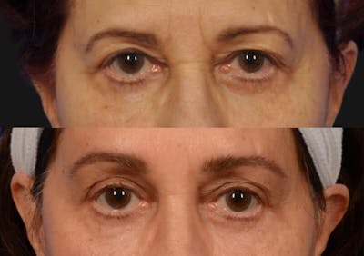 Brow Lift Before & After Gallery - Patient 577902 - Image 2