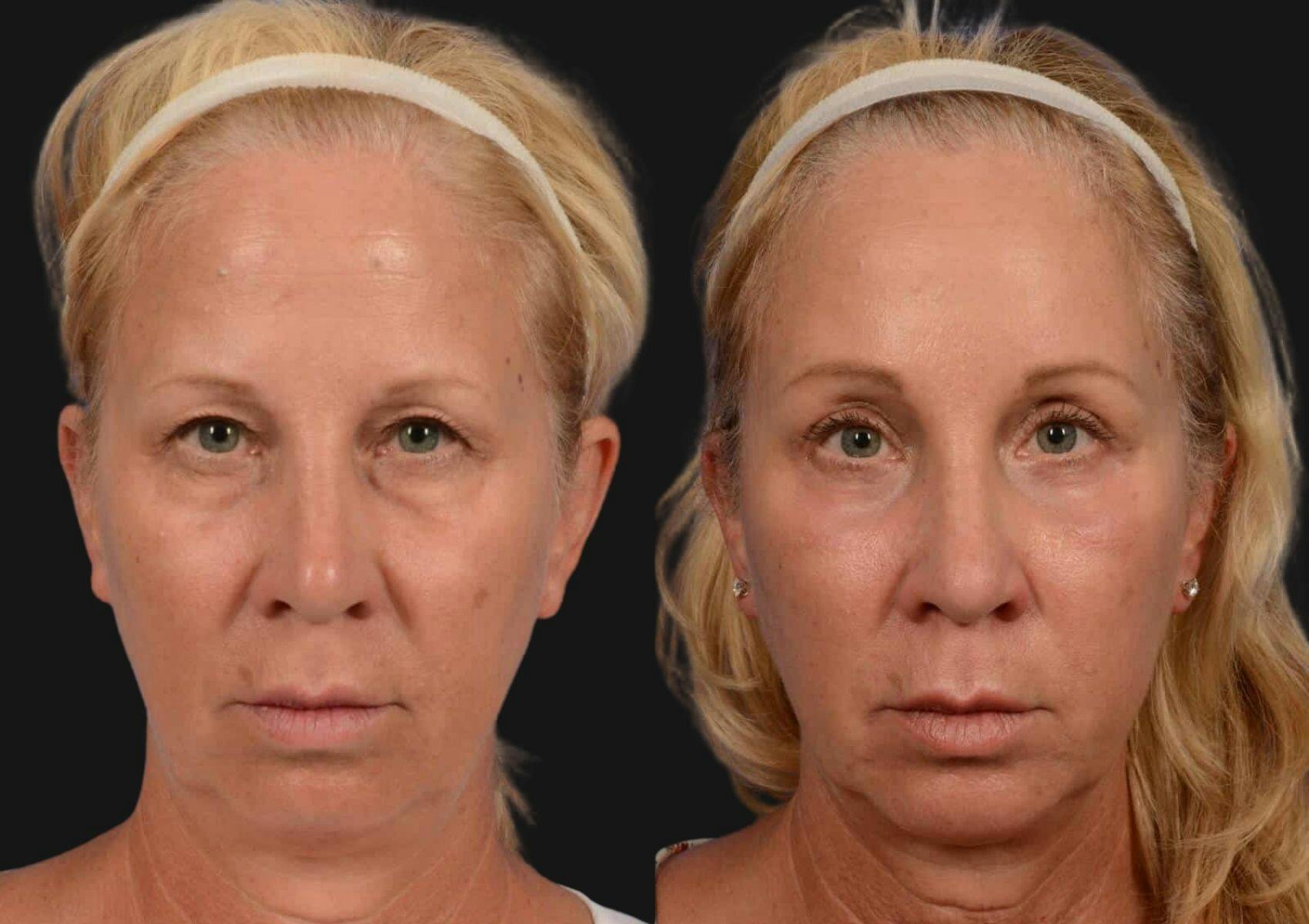 Brow Lift Before & After Gallery - Patient 331176 - Image 1