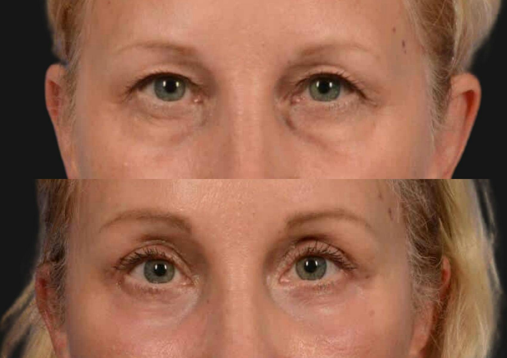 Brow Lift Before & After Gallery - Patient 331176 - Image 2