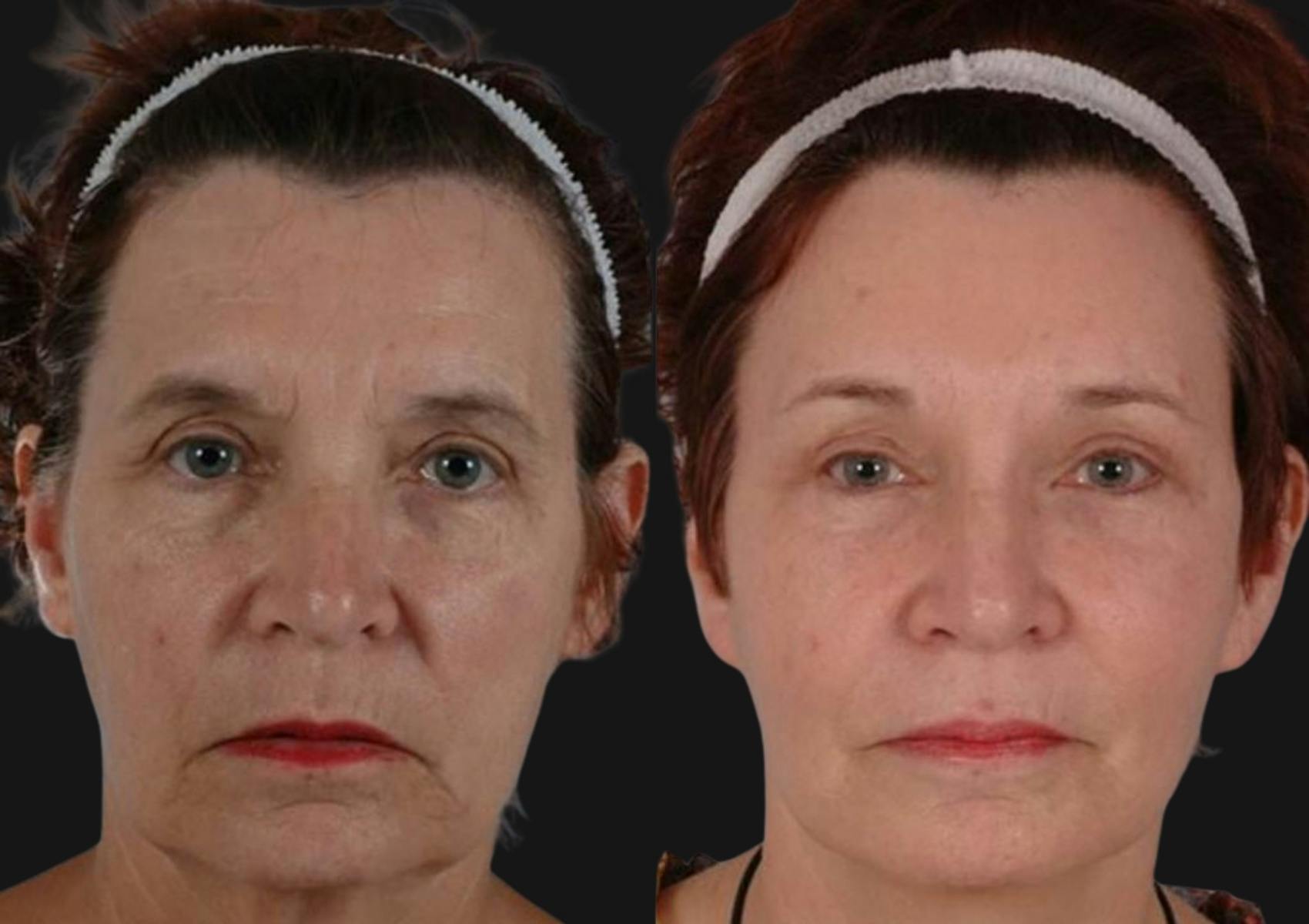 Brow Lift Before & After Gallery - Patient 118427 - Image 1