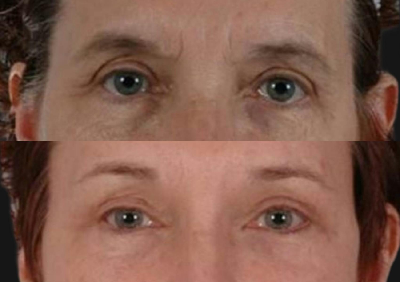 Brow Lift Before & After Gallery - Patient 118427 - Image 2