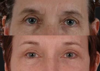 Brow Lift Before & After Gallery - Patient 118427 - Image 2