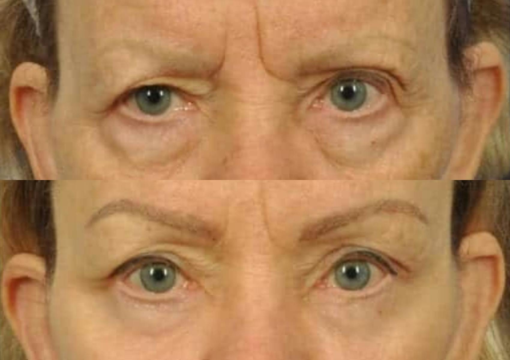 Brow Lift Before & After Gallery - Patient 292169 - Image 2