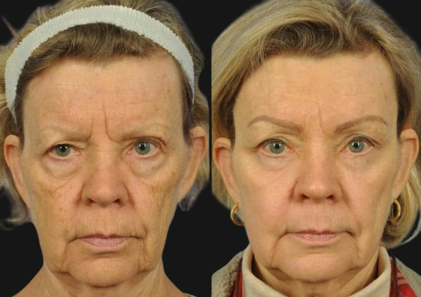 Brow Lift Before & After Gallery - Patient 292169 - Image 1