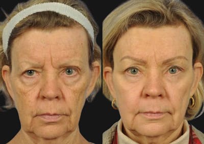 Brow Lift Before & After Gallery - Patient 292169 - Image 1
