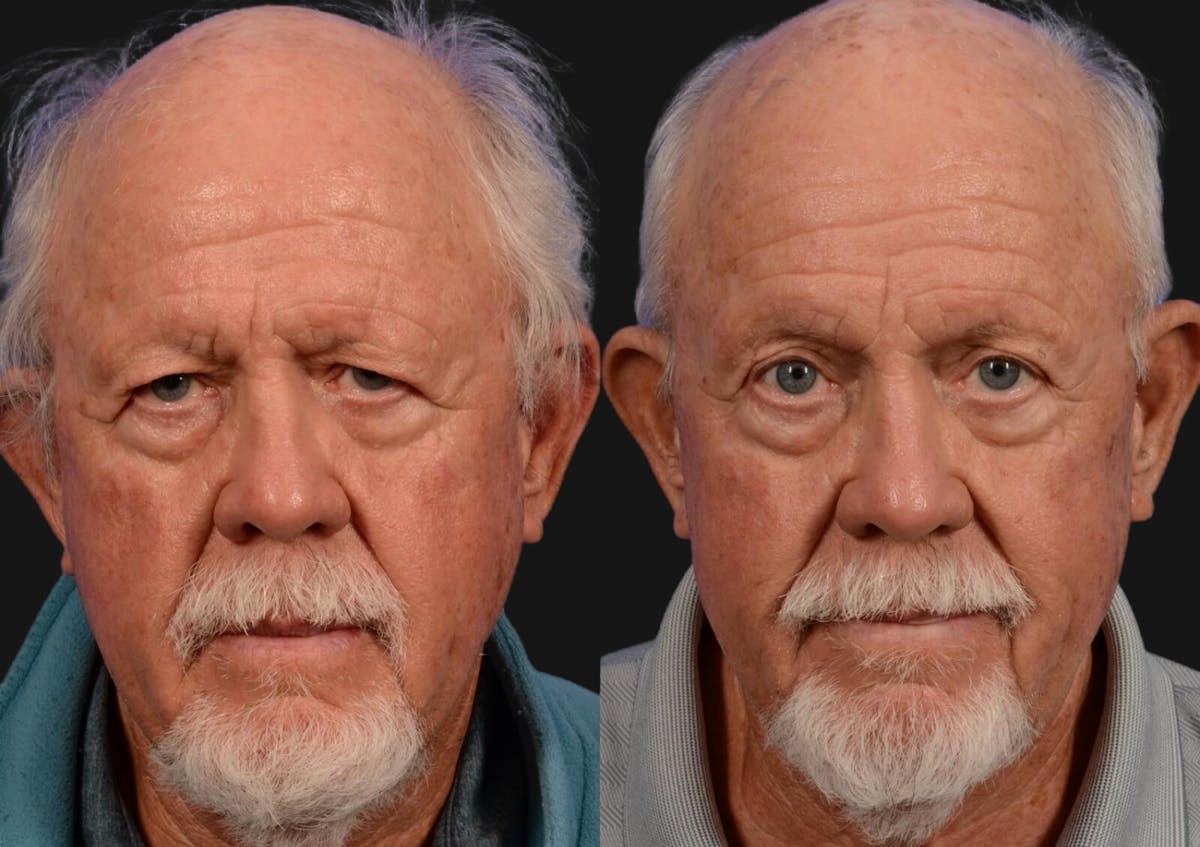 Brow Lift Before & After Gallery - Patient 276000 - Image 1