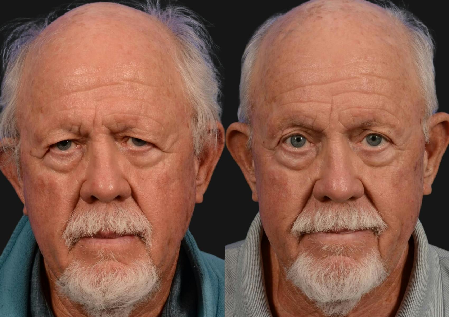 Brow Lift Before & After Gallery - Patient 276000 - Image 1