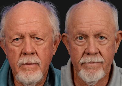 Brow Lift Before & After Gallery - Patient 276000 - Image 1