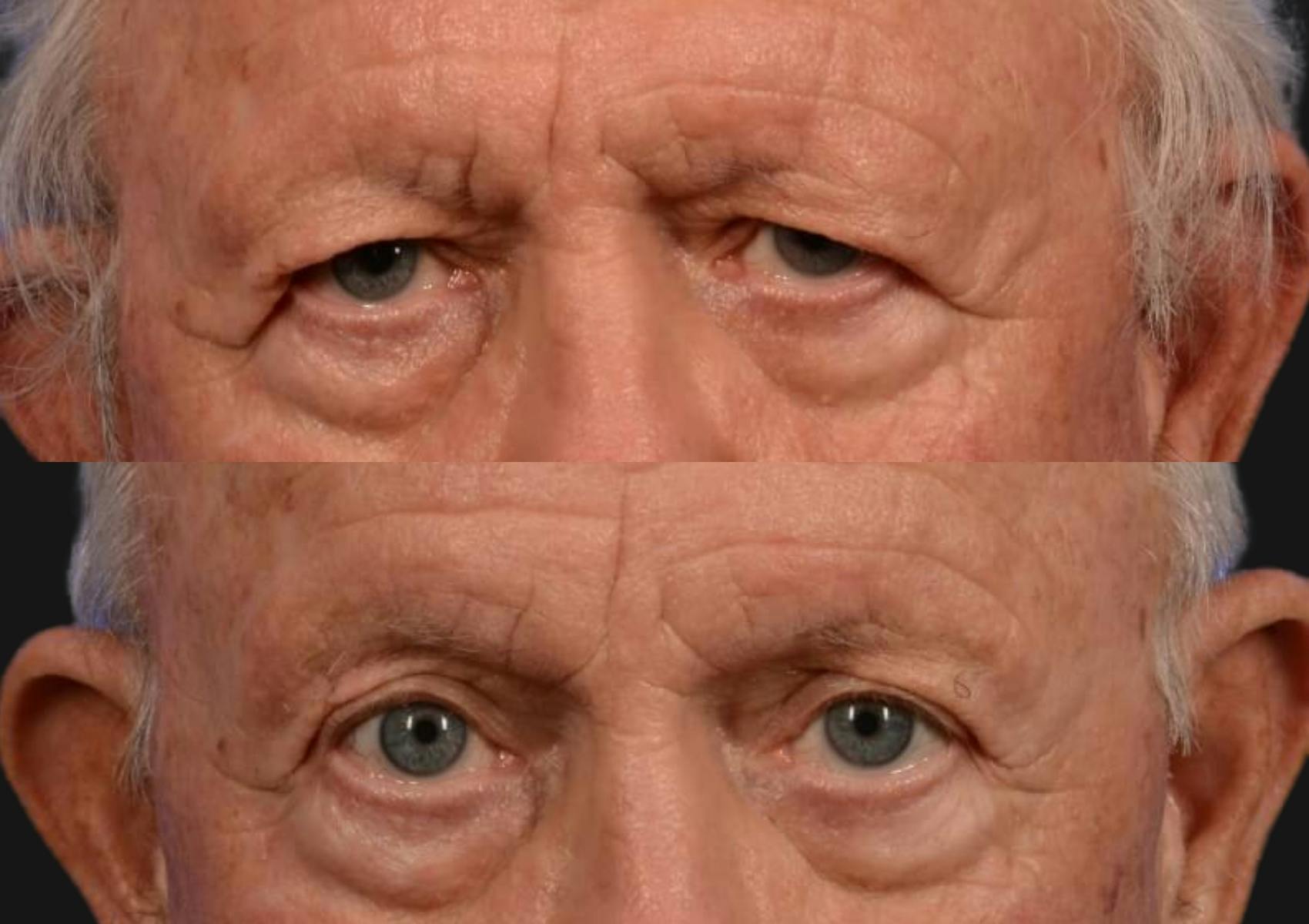 Brow Lift Before & After Gallery - Patient 276000 - Image 2