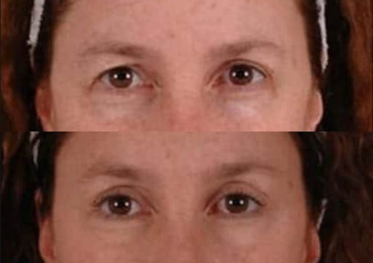 Brow Lift Before & After Gallery - Patient 394130 - Image 2
