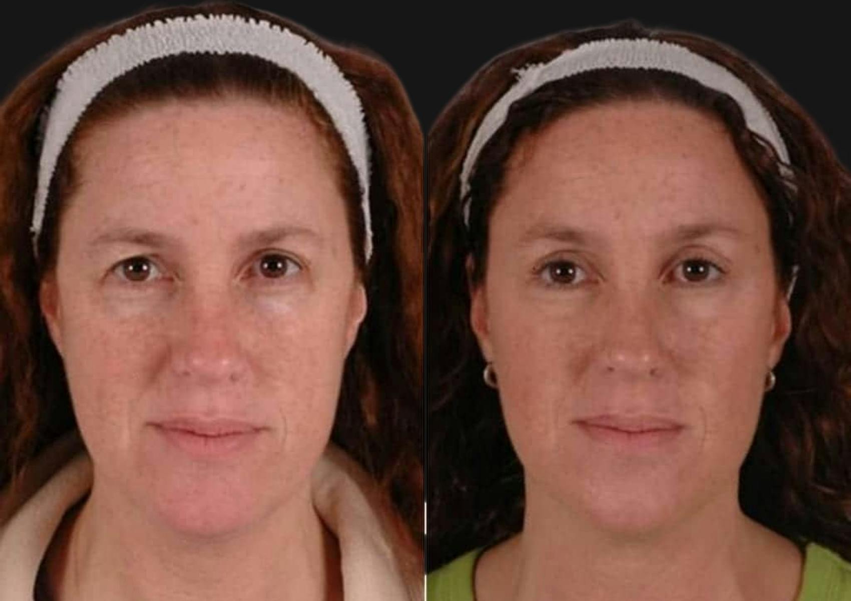 Brow Lift Before & After Gallery - Patient 394130 - Image 1