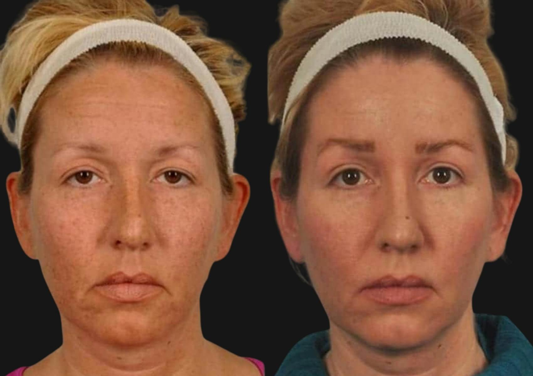 Brow Lift Before & After Gallery - Patient 240708 - Image 1
