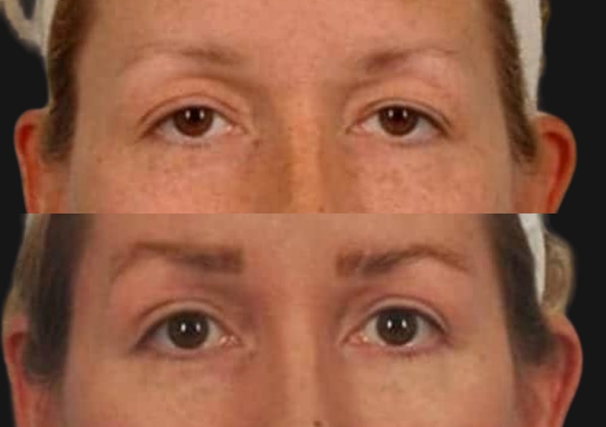 Brow Lift Before & After Gallery - Patient 240708 - Image 2