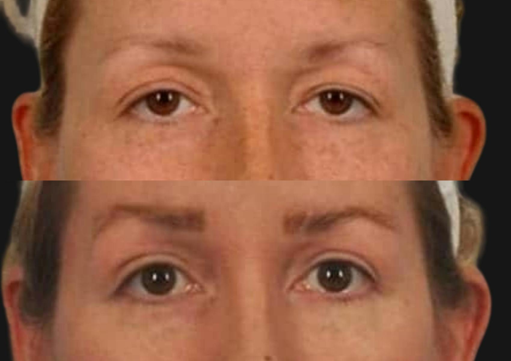 Brow Lift Before & After Gallery - Patient 240708 - Image 2