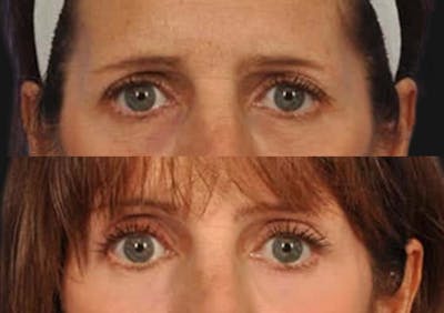 Brow Lift Before & After Gallery - Patient 320623 - Image 2