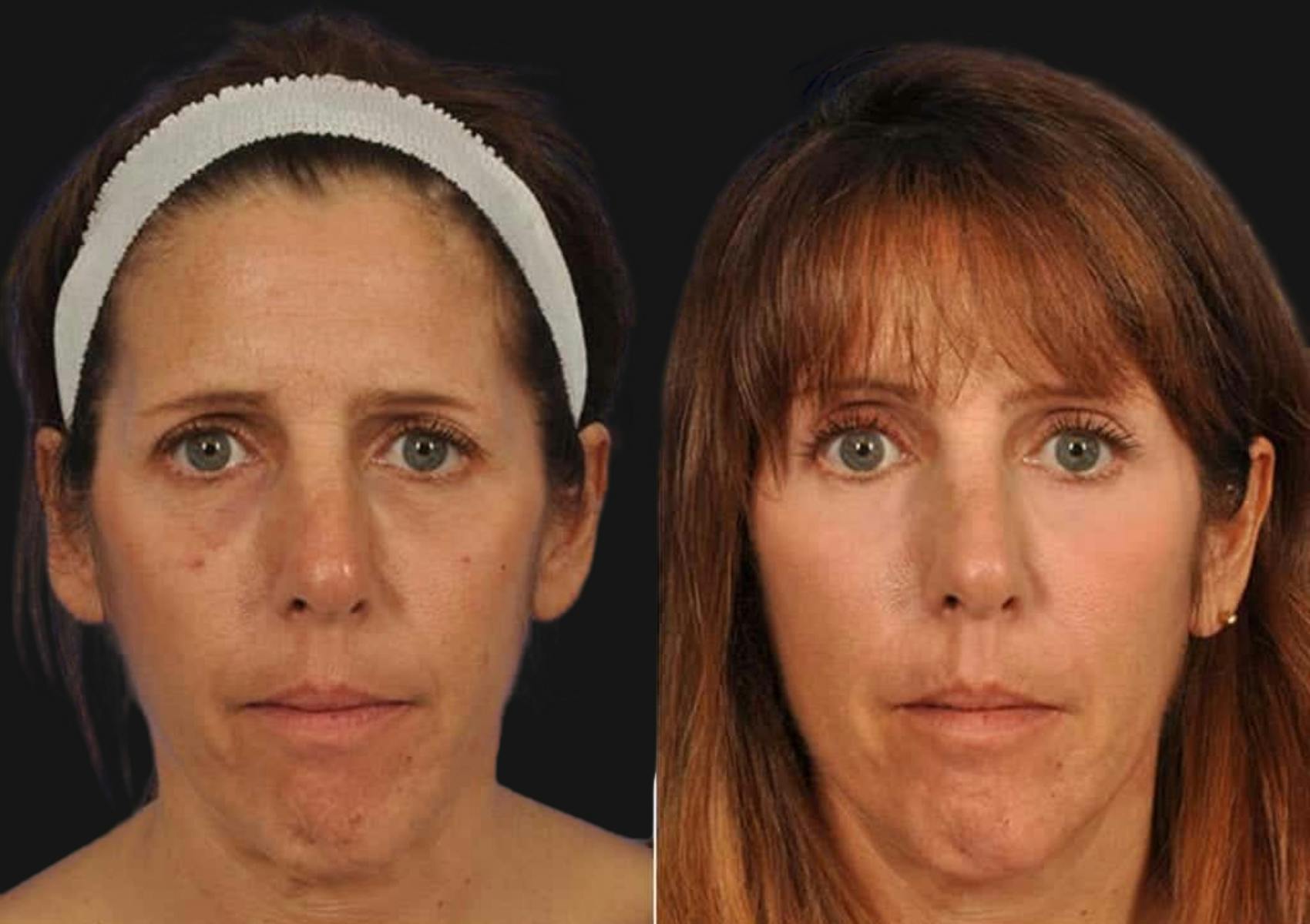 Brow Lift Before & After Gallery - Patient 320623 - Image 1