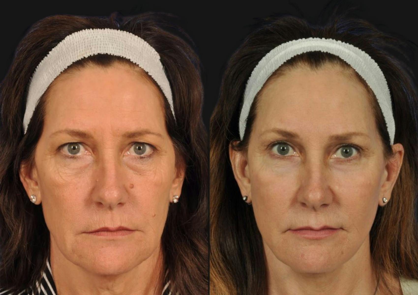 Brow Lift Before & After Gallery - Patient 295719 - Image 1