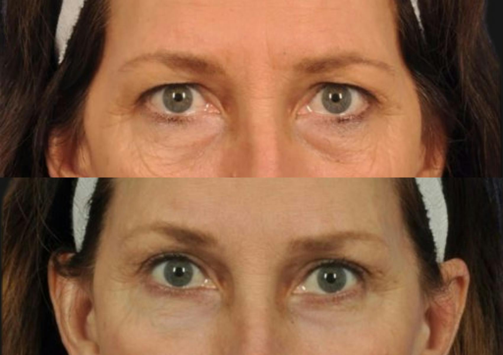 Brow Lift Before & After Gallery - Patient 295719 - Image 2
