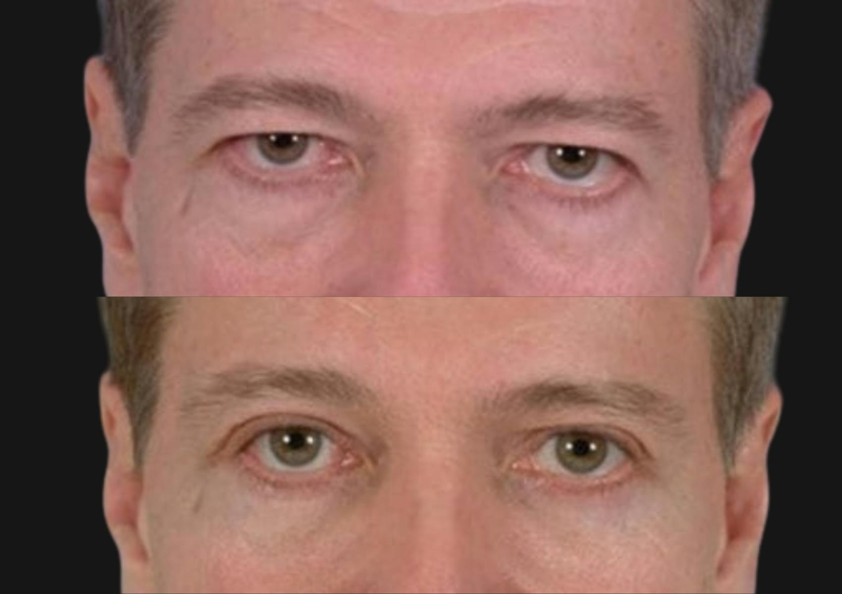 Brow Lift Before & After Gallery - Patient 637895 - Image 2