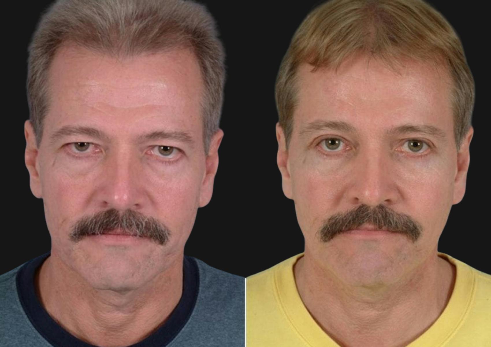 Brow Lift Before & After Gallery - Patient 637895 - Image 1