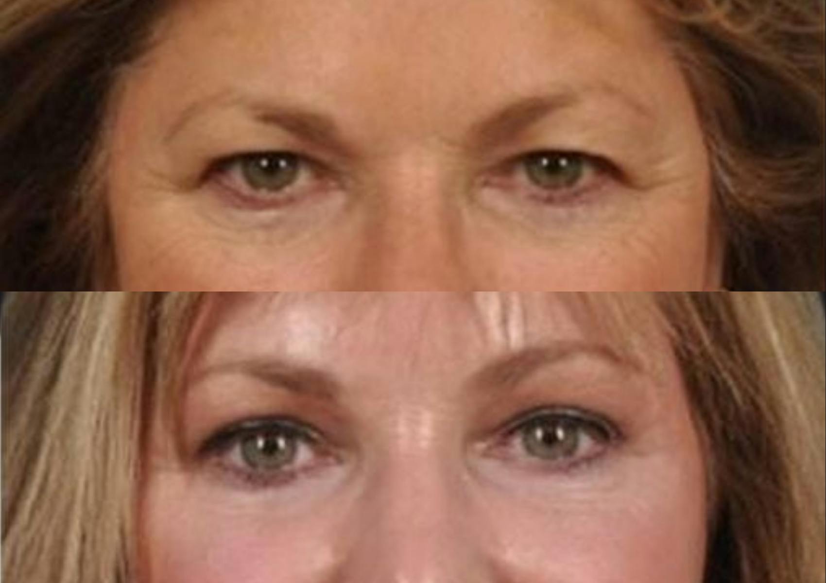 Brow Lift Before & After Gallery - Patient 211160 - Image 2