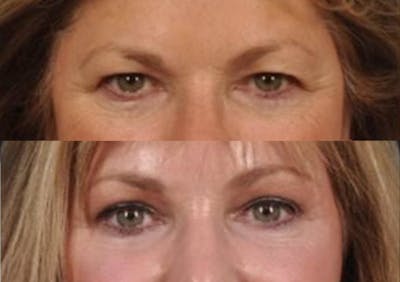 Brow Lift Before & After Gallery - Patient 211160 - Image 2