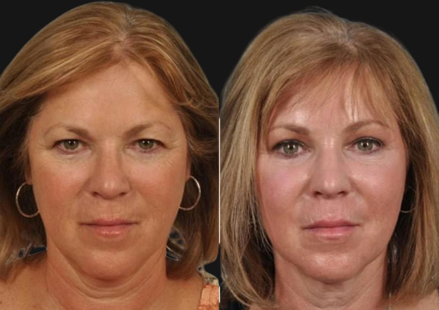 Brow Lift Before & After Gallery - Patient 211160 - Image 1