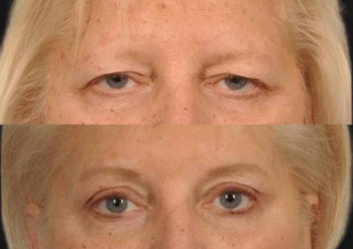 Brow Lift Before & After Gallery - Patient 186021 - Image 2