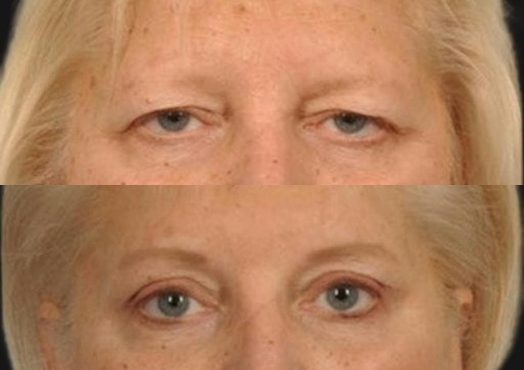 Brow Lift Before & After Gallery - Patient 186021 - Image 2