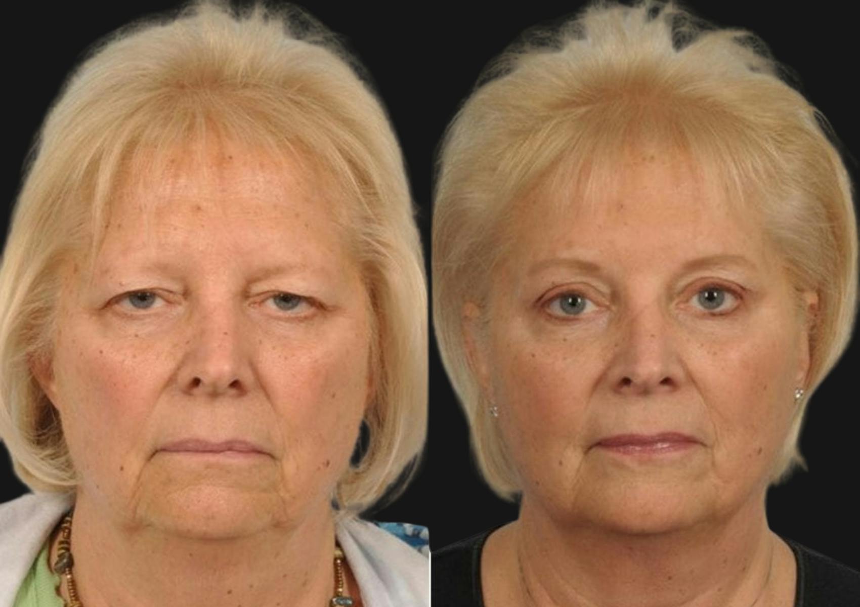 Brow Lift Before & After Gallery - Patient 186021 - Image 1