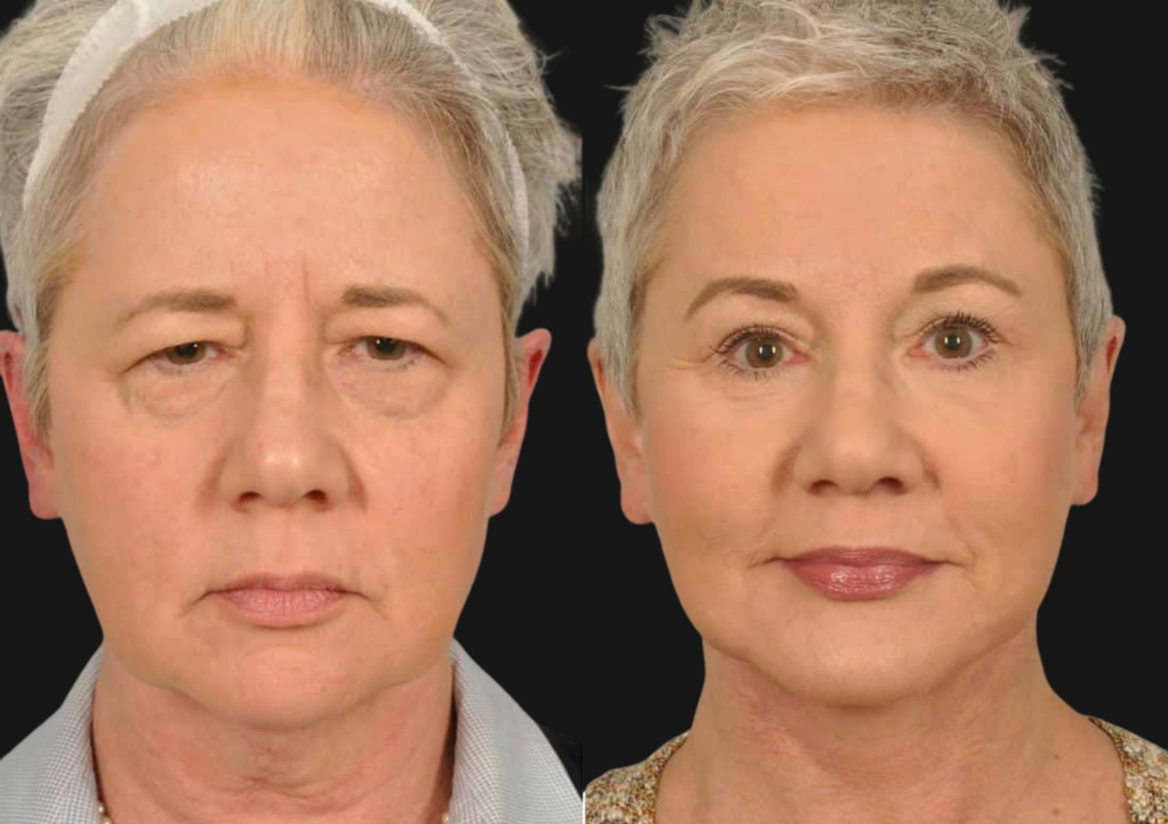 Brow Lift Before & After Gallery - Patient 857156 - Image 1