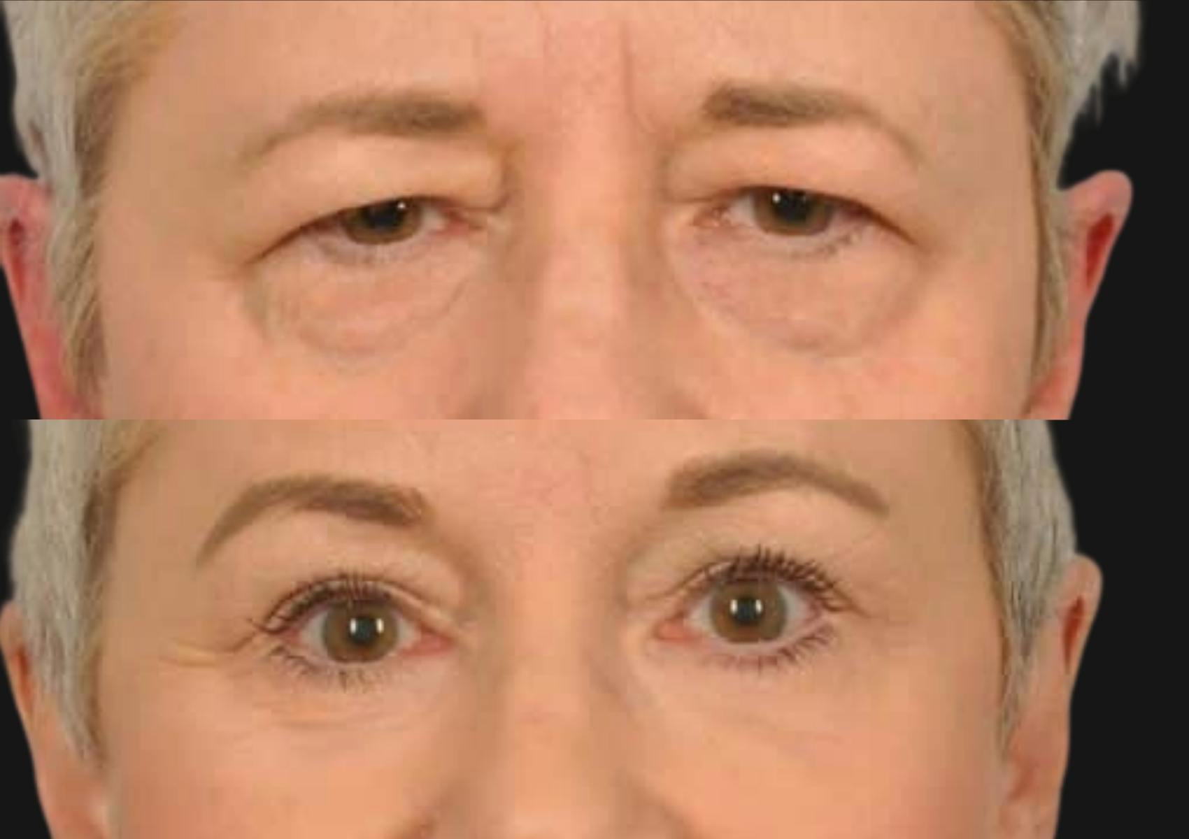 Brow Lift Before & After Gallery - Patient 857156 - Image 2