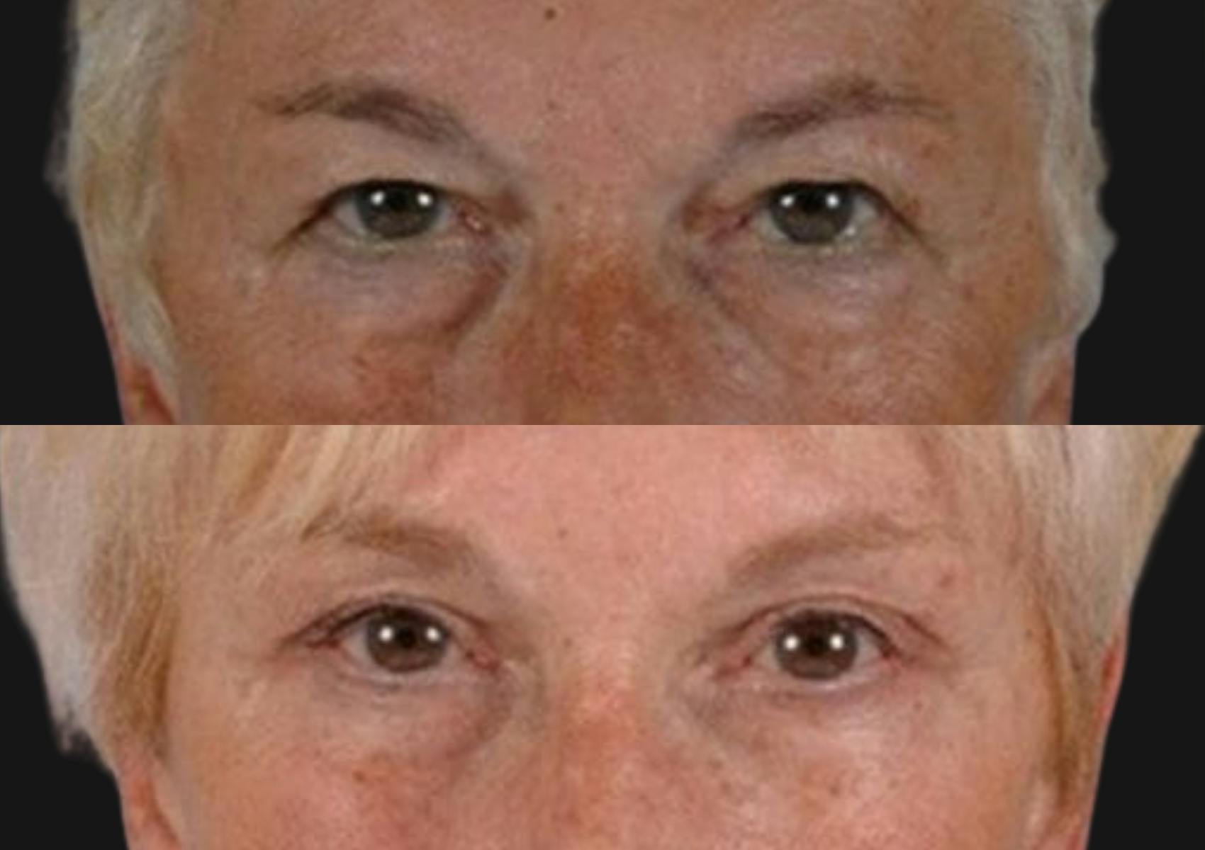 Brow Lift Before & After Gallery - Patient 418562 - Image 2