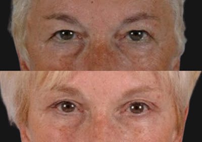Brow Lift Before & After Gallery - Patient 418562 - Image 2