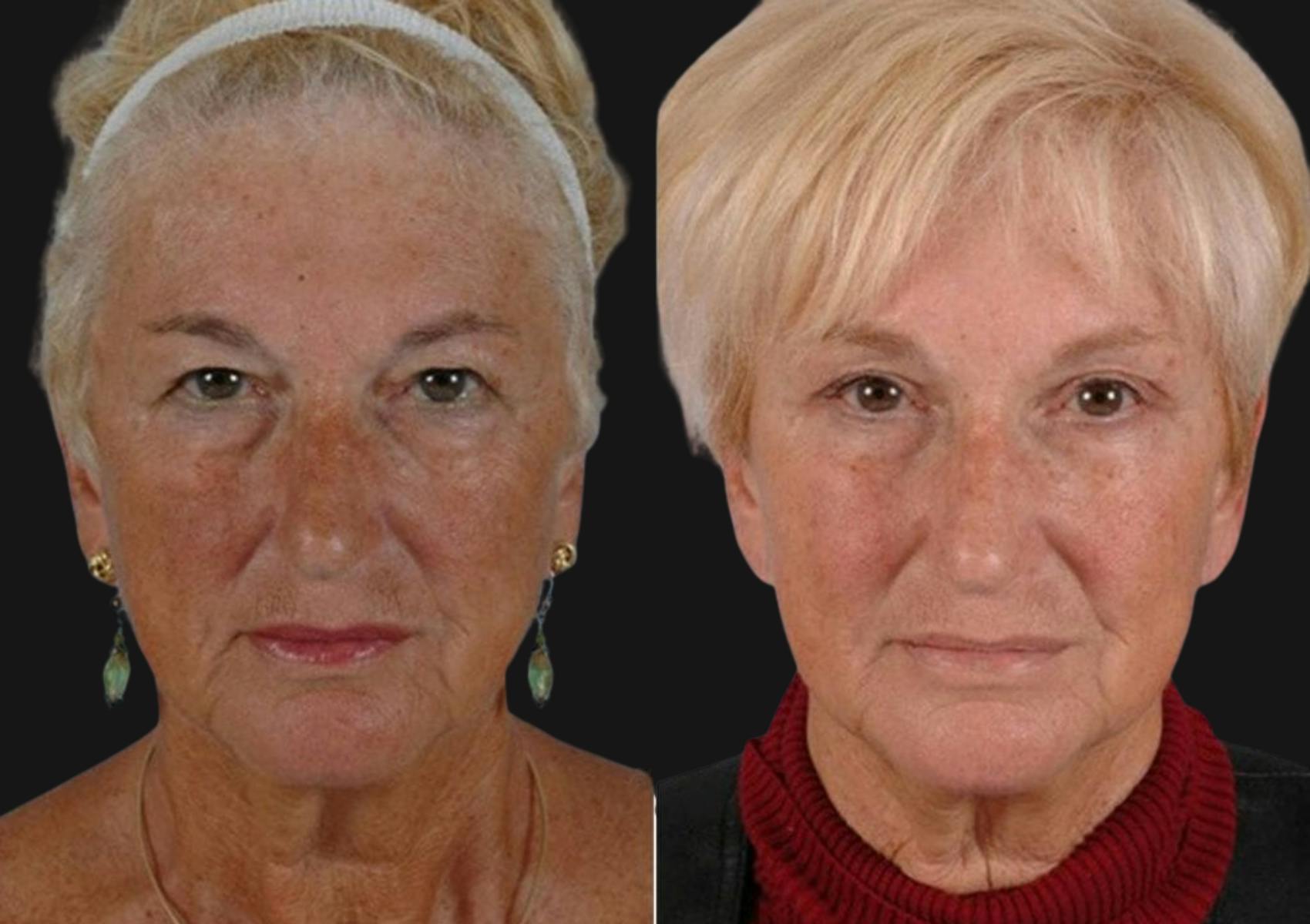 Brow Lift Before & After Gallery - Patient 418562 - Image 1