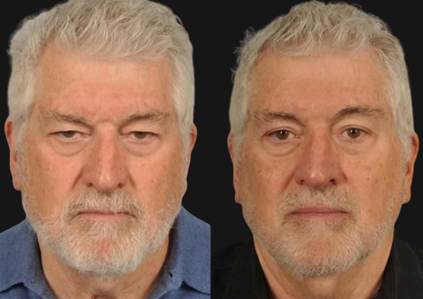 Brow Lift Before & After Gallery - Patient 369262 - Image 1