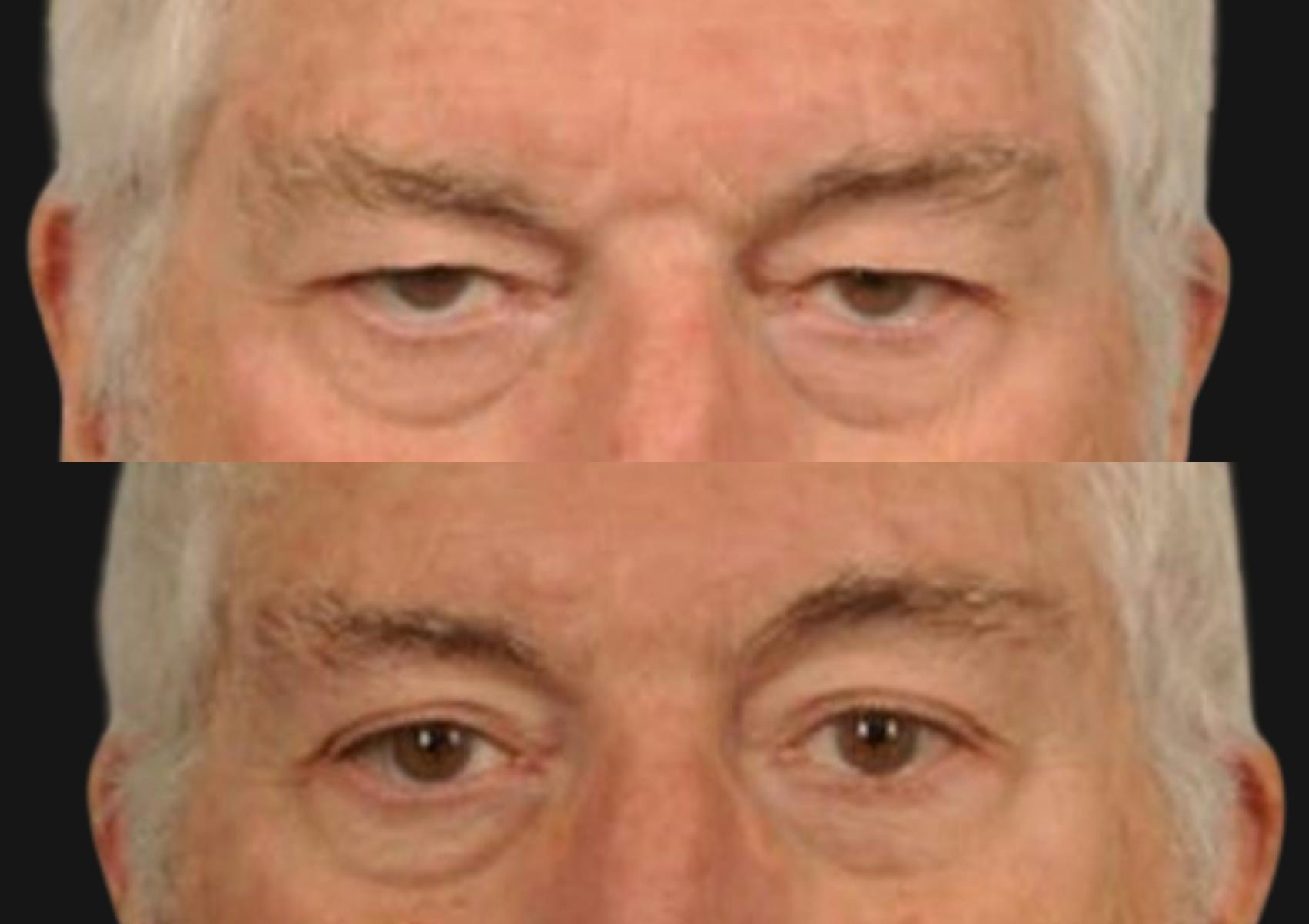 Brow Lift Before & After Gallery - Patient 369262 - Image 2