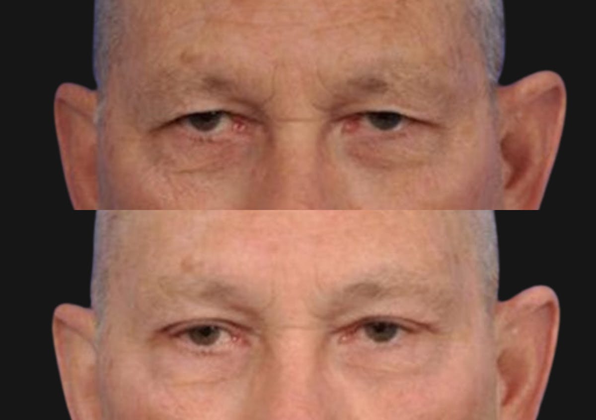 Brow Lift Before & After Gallery - Patient 324716 - Image 1