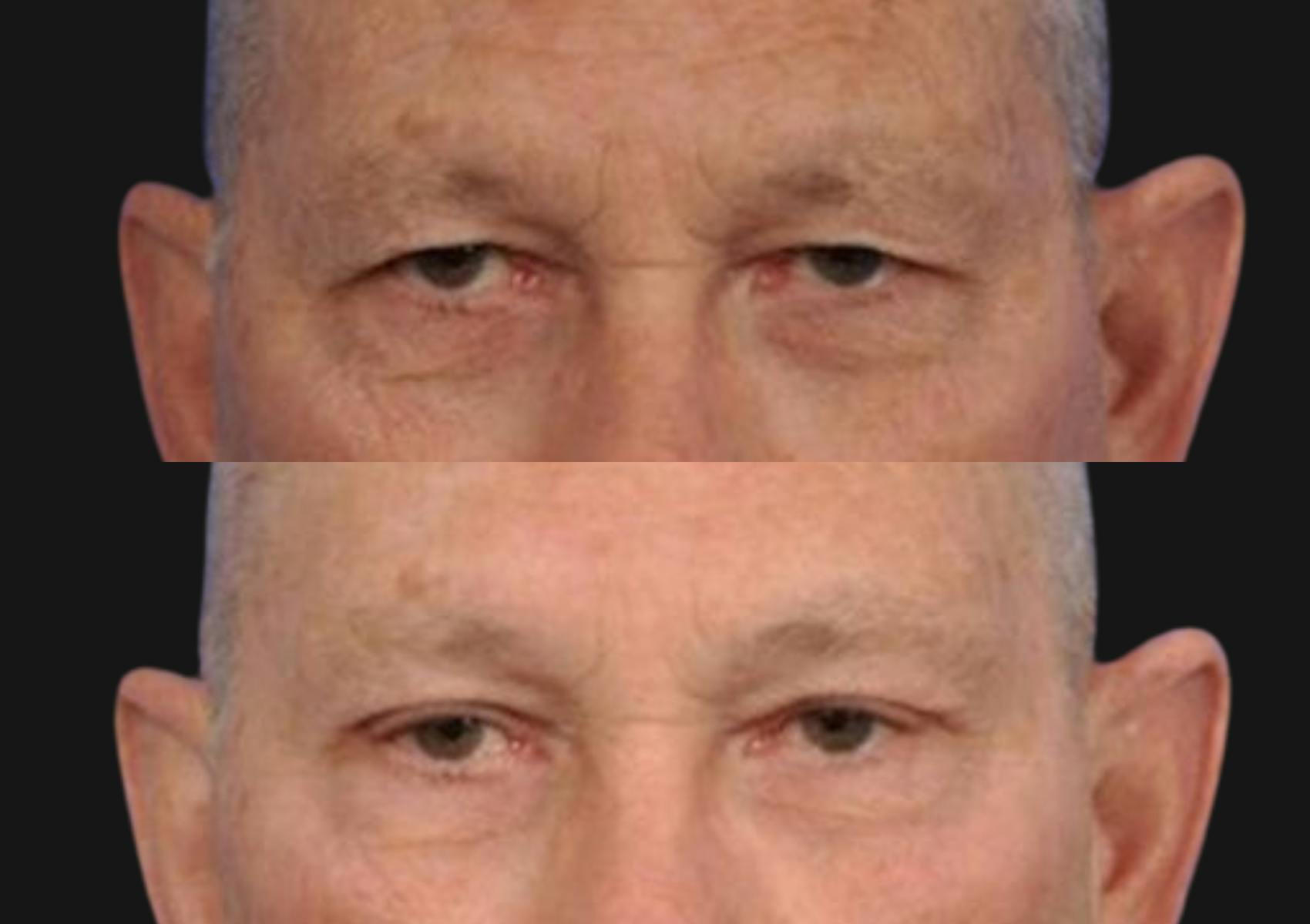 Brow Lift Before & After Gallery - Patient 324716 - Image 1