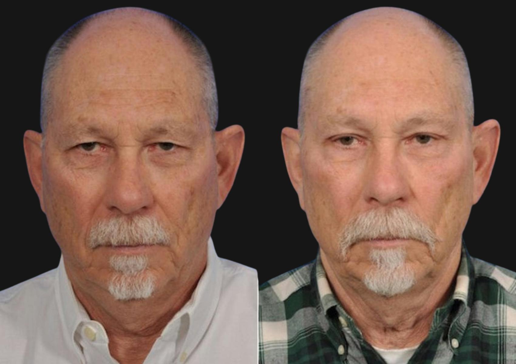 Brow Lift Before & After Gallery - Patient 324716 - Image 2