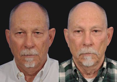 Brow Lift Before & After Gallery - Patient 324716 - Image 2