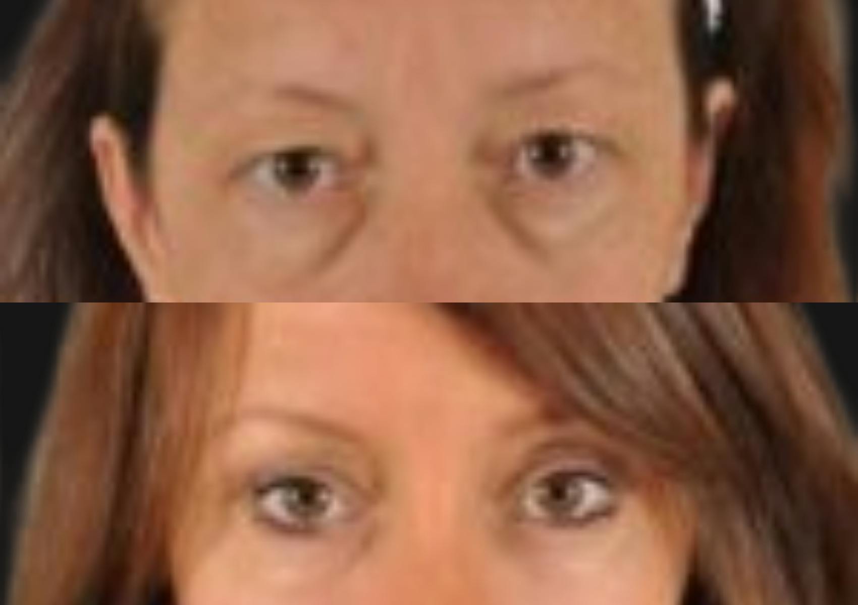 Brow Lift Before & After Gallery - Patient 187455 - Image 2