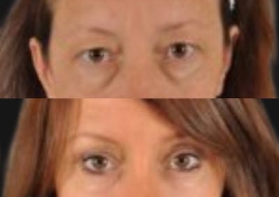 Brow Lift Before & After Gallery - Patient 187455 - Image 2
