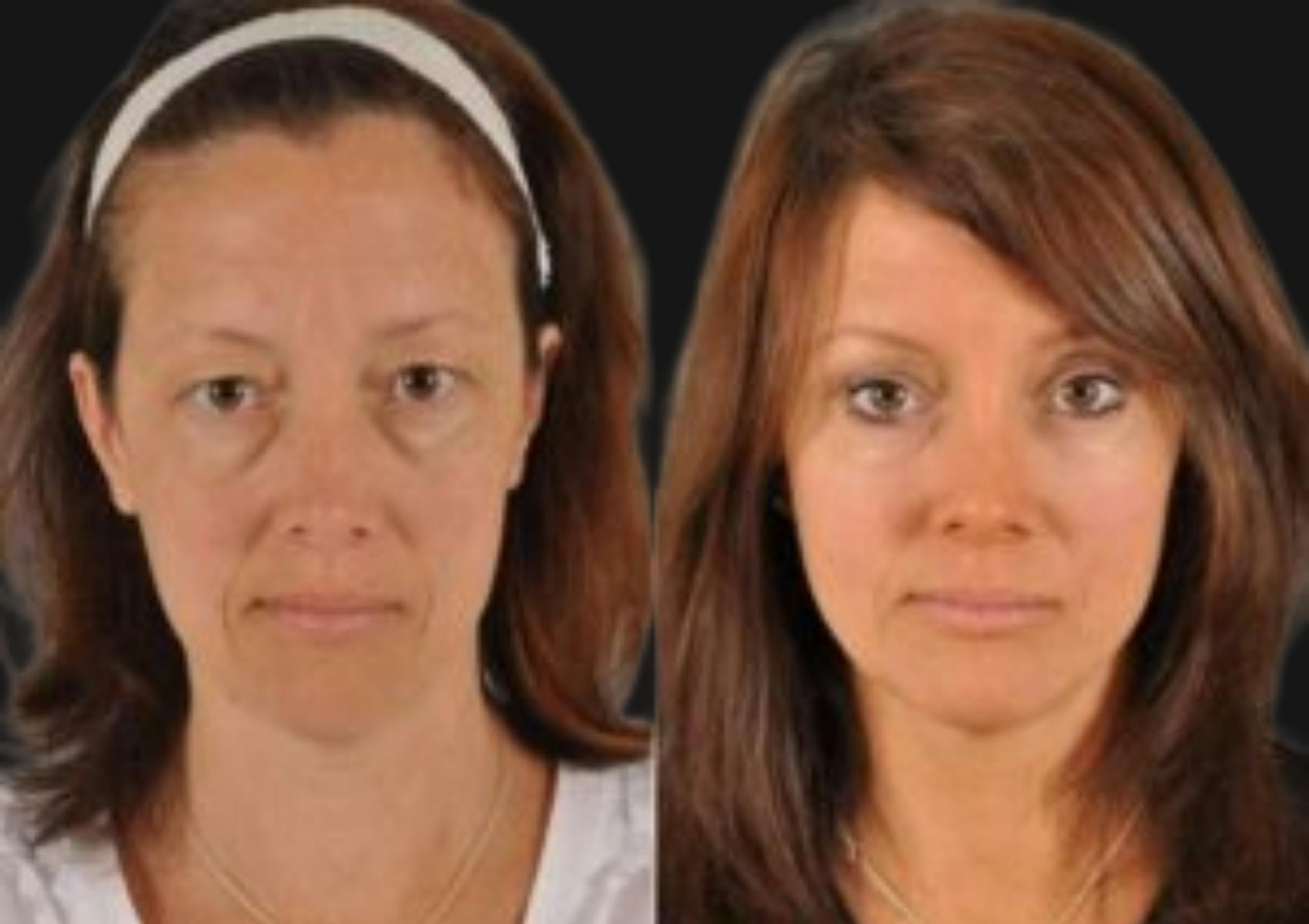 Brow Lift Before & After Gallery - Patient 187455 - Image 1