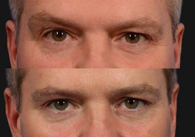 Brow Lift Before & After Gallery - Patient 198008 - Image 2